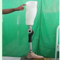 Meththa Above Knee prosthesis
